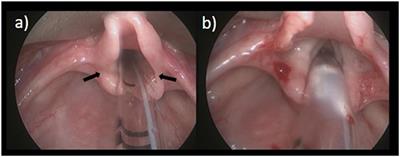 Pediatric Airway Pathology